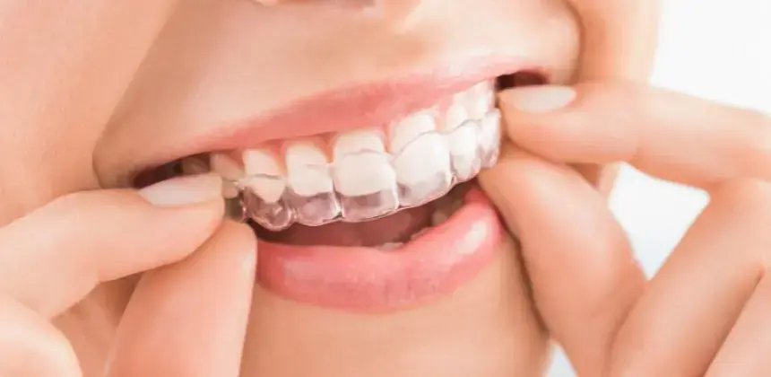 Persona colocando un alineador dental transparente sobre sus dientes